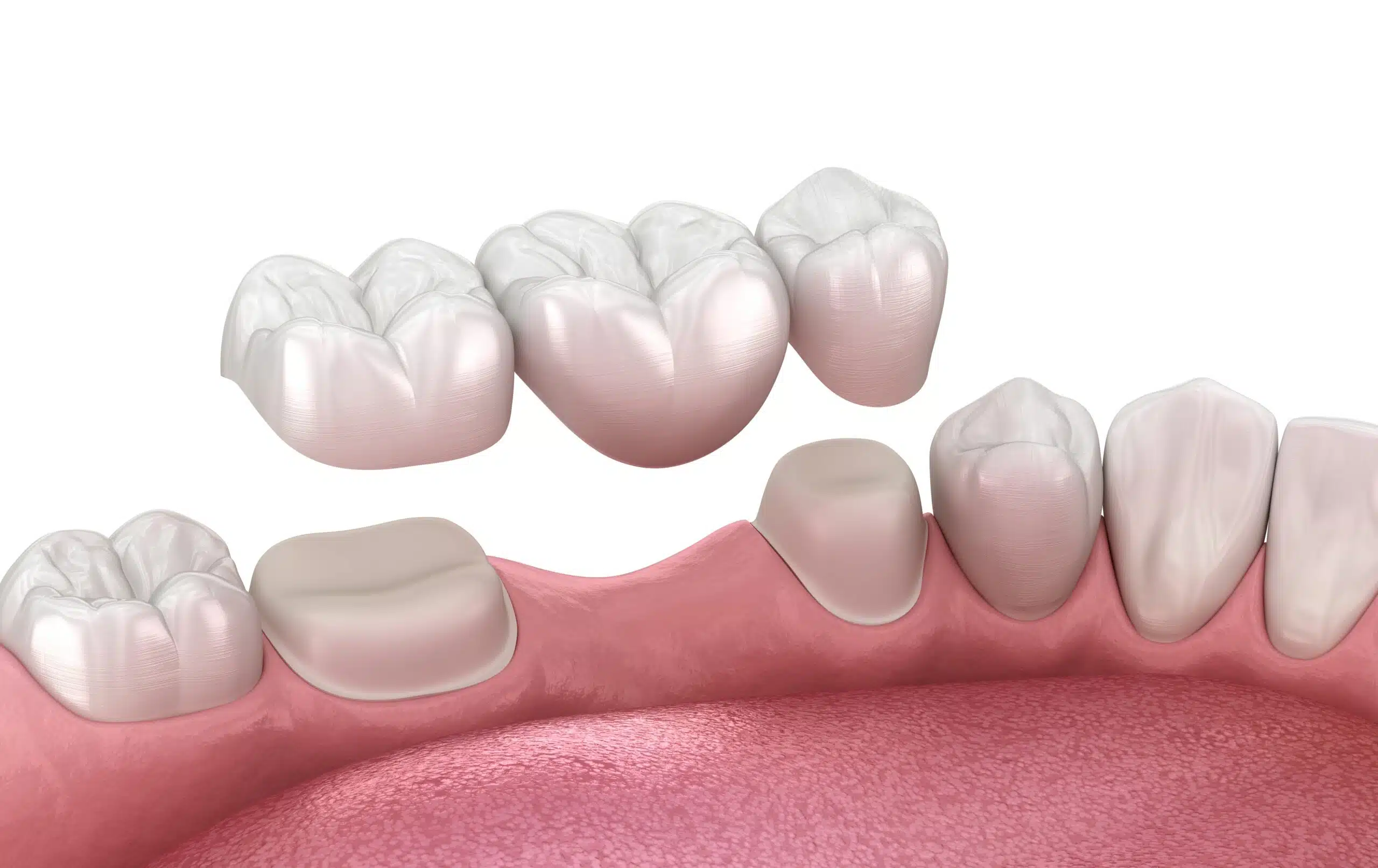Illustration of a dental bridge replacing missing teeth
