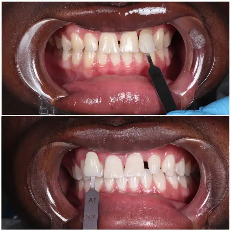 Before and after smile showing professional teeth whitening results