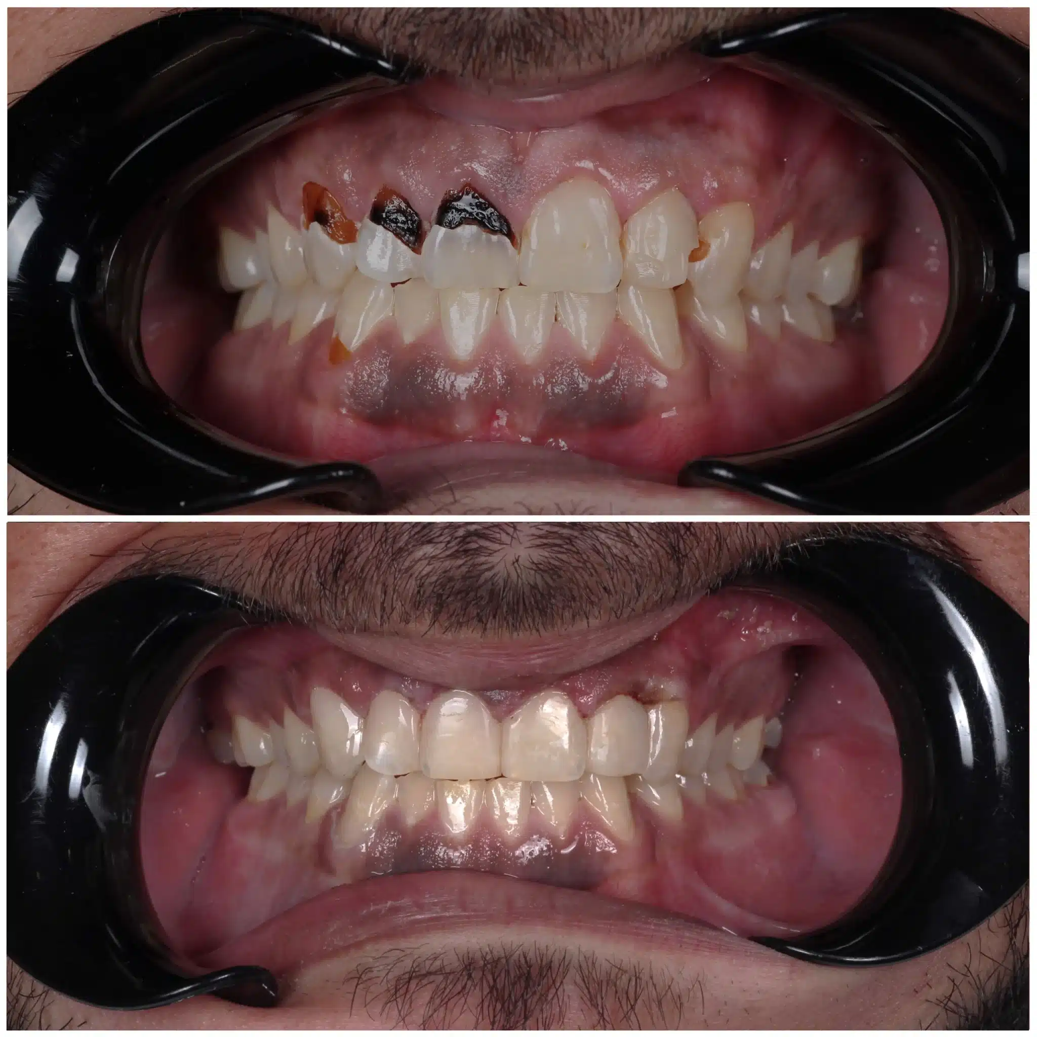 Before and after cosmetic bonding for damaged front teeth