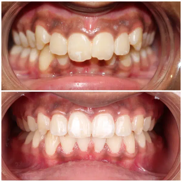 Before and after cosmetic bonding to improve the appearance of front teeth