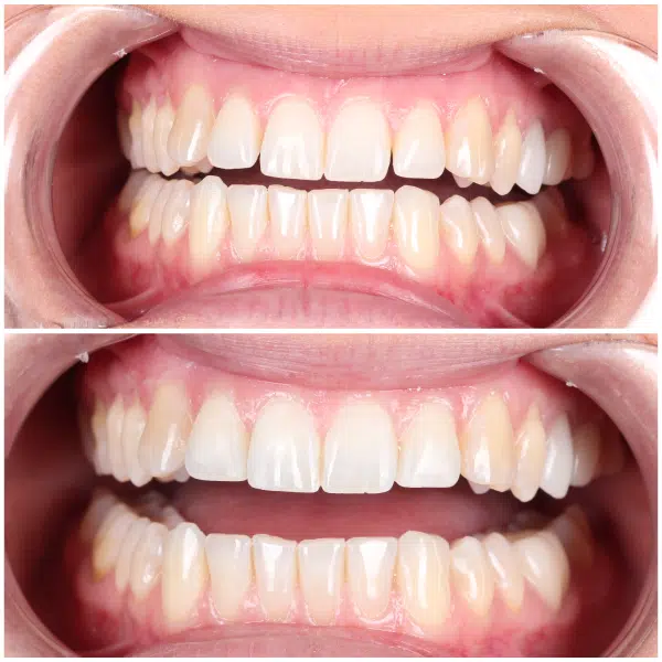 Before and after cosmetic bonding showing an improved smile
