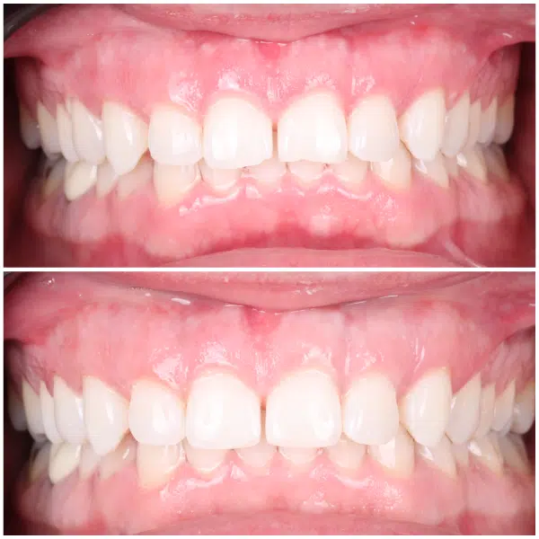 Before and after cosmetic bonding showing improved front tooth shape