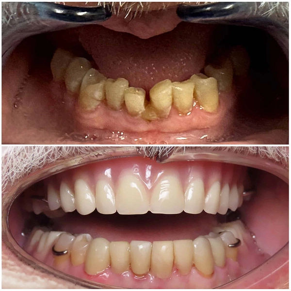 Before and after crown and bridge treatment showing restored teeth and smile