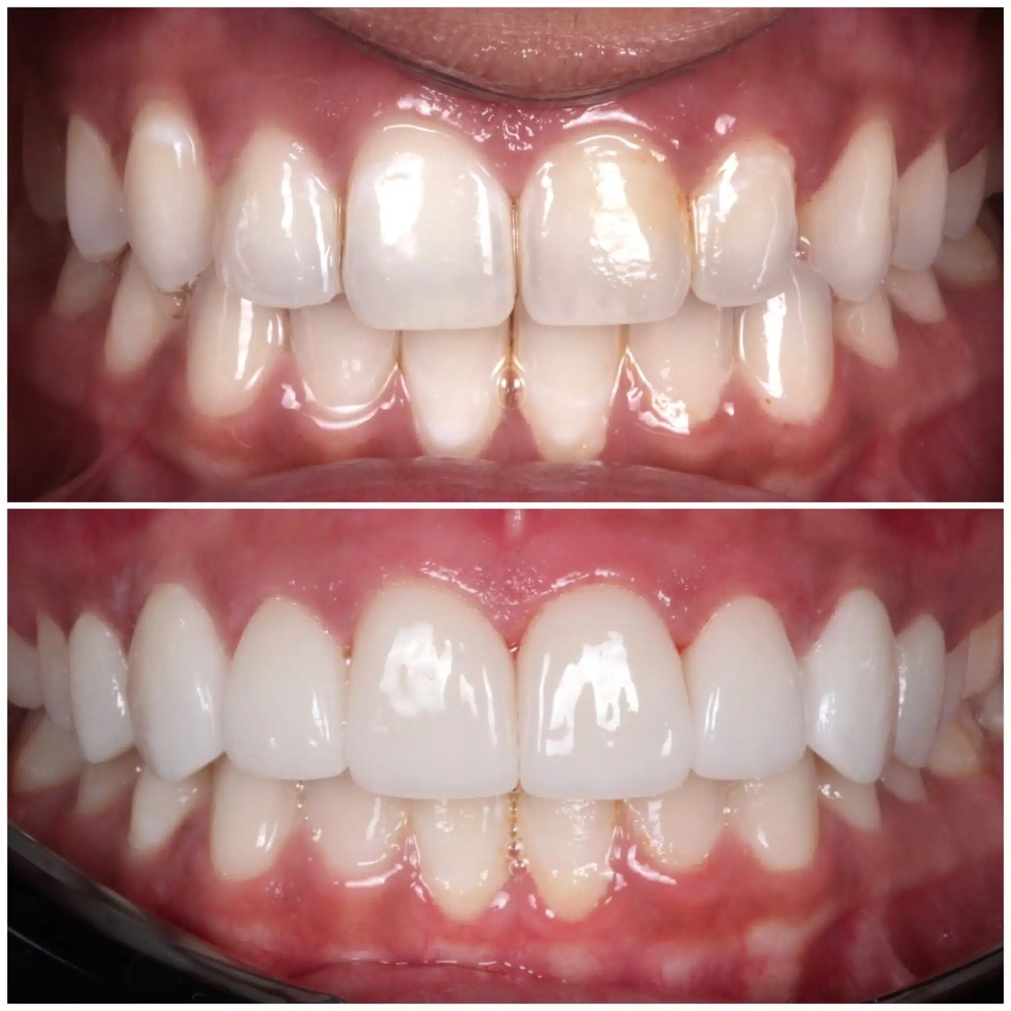 Before and after porcelain veneers showing a transformed smile