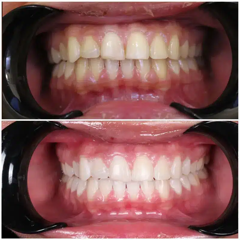 Before and after results of professional teeth whitening