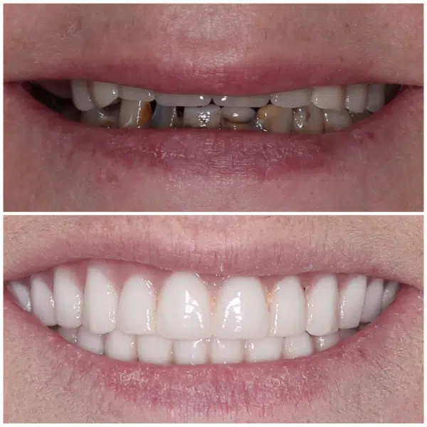 Before and after smile makeover showing a brighter, more even smile