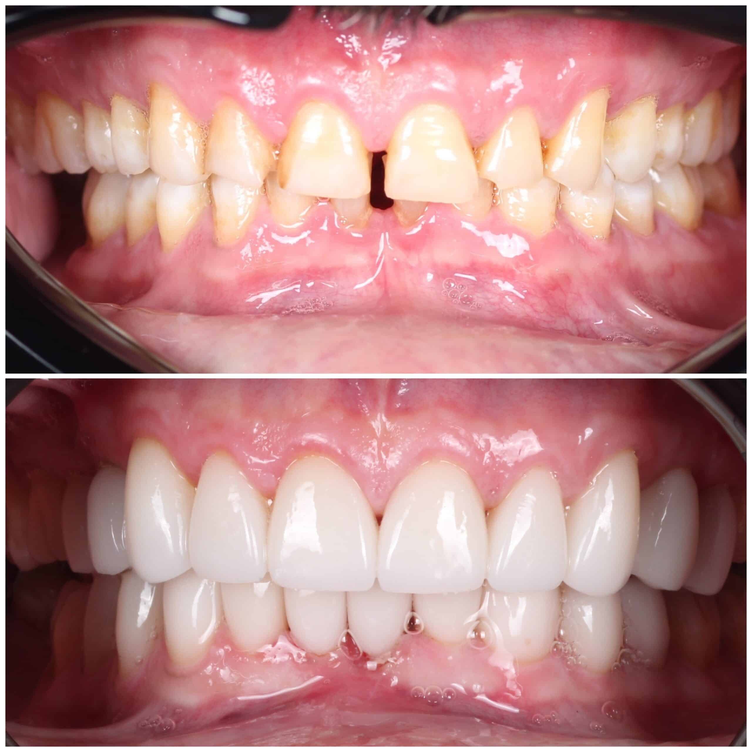 Before and after smile makeover showing improvement in tooth gaps and appearance