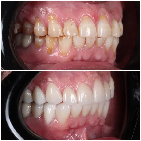 Before and after smile makeover showing improved tooth shape and color