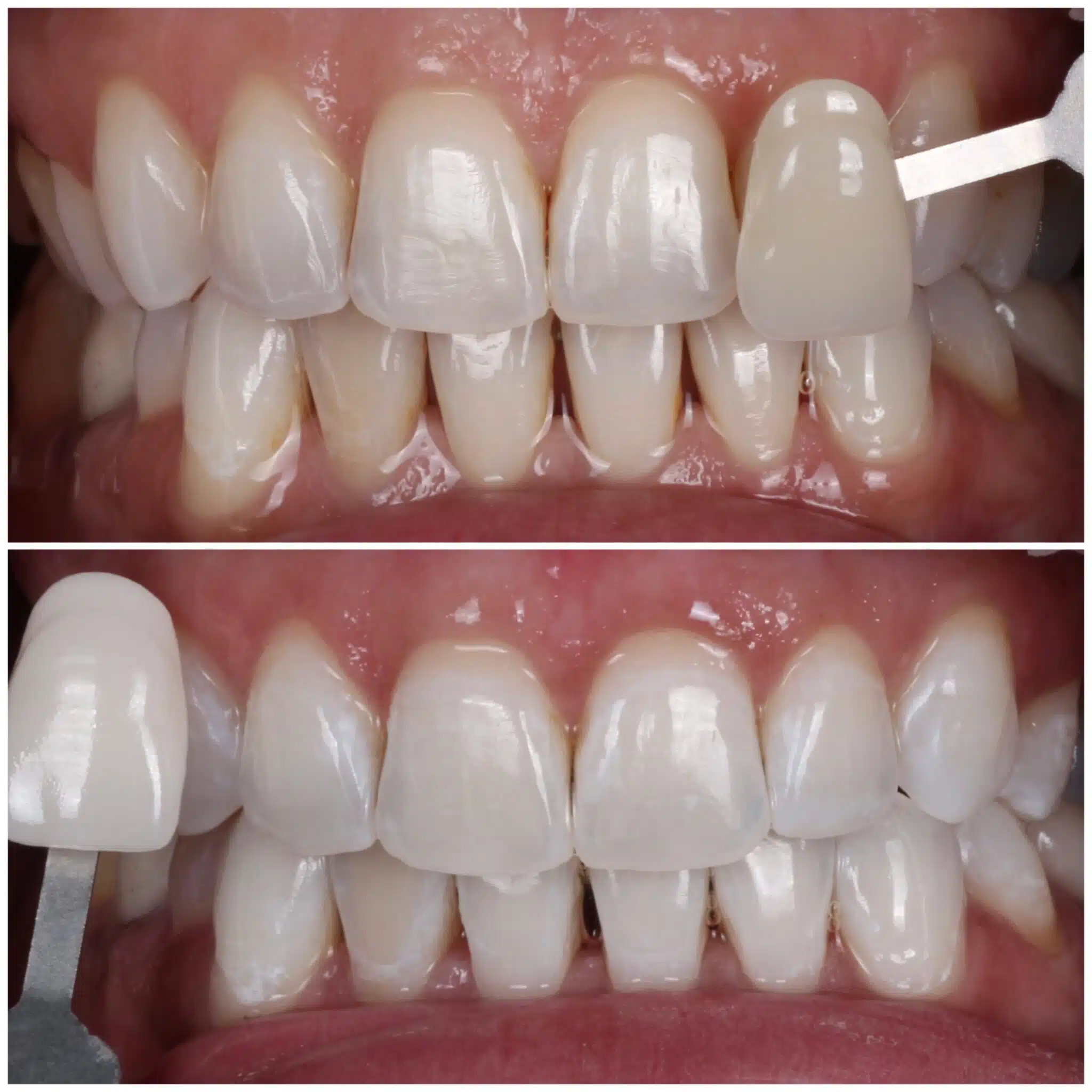 Teeth shade comparison before and after professional whitening